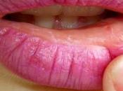 Cómo calmar labios secos agrietados remedios naturales