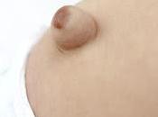 Hernia Umbilical