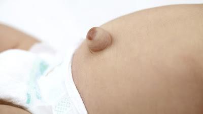 Hernia Umbilical