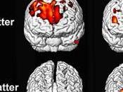 Anatomia Masculina Cerebro Predispone Autismo
