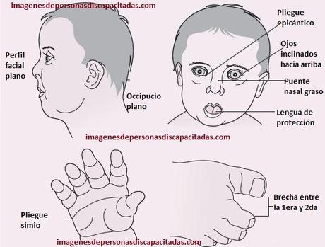 sintomas de sindrome de down en bebes embarazo