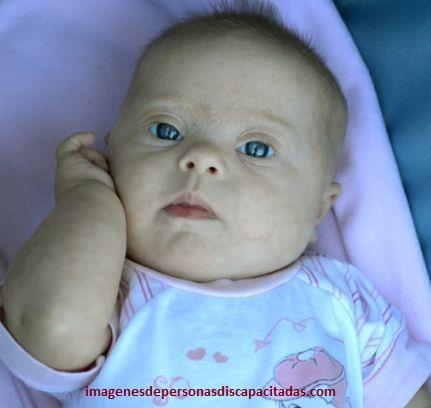 sintomas de sindrome de down en bebes nacer