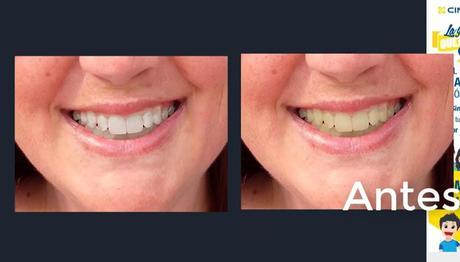 Blanquear los dientes en fotografías