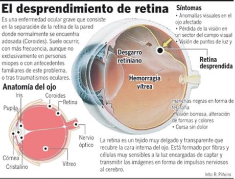 Mi experiencia con un desprendimiento de retina (editado)