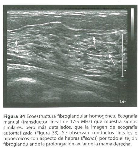 BIRADS POR ULTRASONIDO IMAGENES