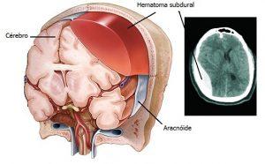 Hematoma subdural crónico en pacientes muy ancianos.