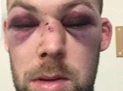 cómo quedó rostro jugador criquet luego romperse huesos #Deportes (FOTO)