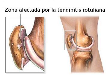 ¿Cómo prevenir las lesiones más comunes en el ciclismo?