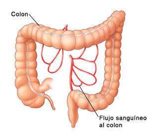 Causas de la colitis isquémica