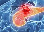Cáncer páncreas