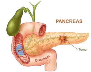 Causas del cáncer de páncreas