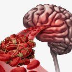 Asociación de uso de drogas antitrombóticas con riesgo de hematoma subdural.