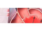 Insuficiencia mitral