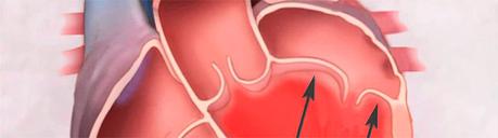 Insuficiencia mitral