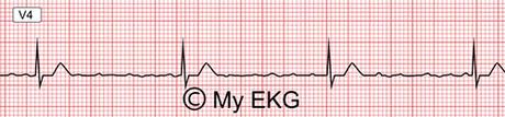 Bloqueo auriculoventricular completo