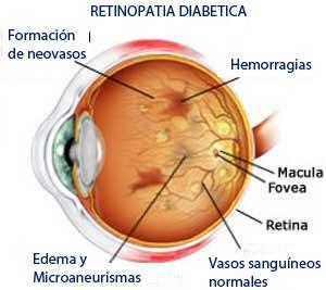 Ojo con retinopatía diabética