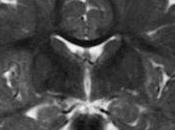 Descubren Causa Enfermedad Alexander