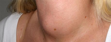 Bocio multinodular tóxico