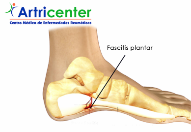 Fibromialgia y dolor de pies