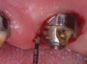 Posibles complicaciones implantes dentales