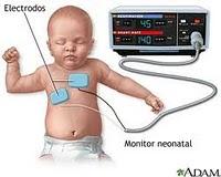 El monitoreo cardíaco fetal reduce la mortalidad infantil