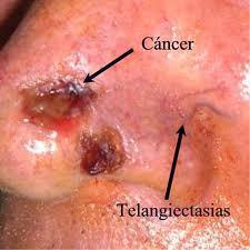 El Instituto dermatológico de Jalisco y su tecnología de punta contra el cáncer de piel