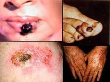 El Instituto dermatológico de Jalisco y su tecnología de punta contra el cáncer de piel