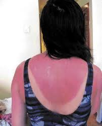 El Instituto dermatológico de Jalisco y su tecnología de punta contra el cáncer de piel