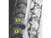 Tratamiento Endoscopico Hernias Discales