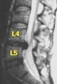 Tratamiento Endoscopico de las Hernias Discales Tratamiento Endoscopico de las Hernias Discales
