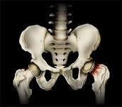 Los Complementos de Calcio Producen Fracturas