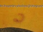 Amniocentesis