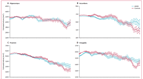 El cerebro de las personas con TDAH sufrirían de un retraso en el proceso de maduración