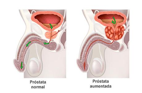 Síntomas de la hiperplasia benigna de próstata