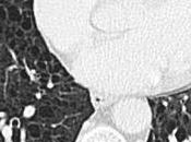 Linfangioleiomiomatosis