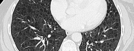Linfangioleiomiomatosis