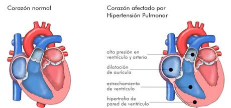 Corazón afectado por hipertensión pulmonar
