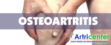 3 preguntas frecuentes de la Osteoartritis