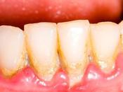 Tratamiento para piorrea encías (Periodontitis)