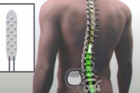 Un dispositivo implantado en la médula osea permite caminar a un paralítico #Salud #Medicina