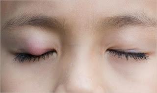 orzuelo en el ojo
