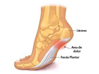 Síntomas del espolón calcáneo