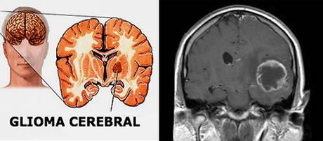 Uso del Mebendazol para Tratar Tumores Cerebrales