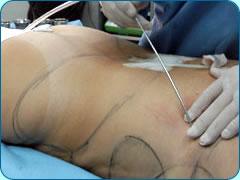 Caso de negligencia médica en anestesia Nº 3: Muerte de una modelo