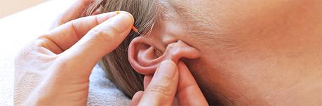 La acupuntura para adelgazar no produce dolor alguno