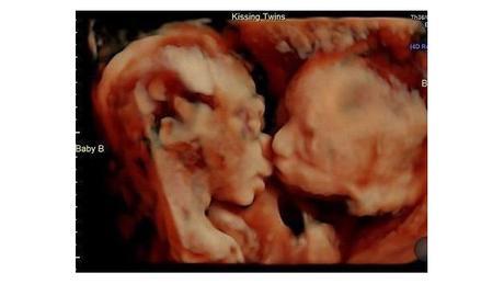 VIRAL: Gemelas se besan en el vientre de su madre