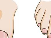 Uñas encarnadas. Sigue estos consejos remedios naturales.