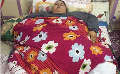 Mujer operada por sobrepeso pierde 240 kilos después de su intervención #Medicina #salud #Mujeres