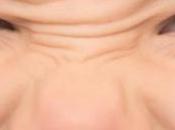 ¿Qué causa ampollas nariz?