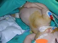 Caso de negligencia médica en anestesia Nº 5: nene cuadripléjico por sobredosis de anestesia